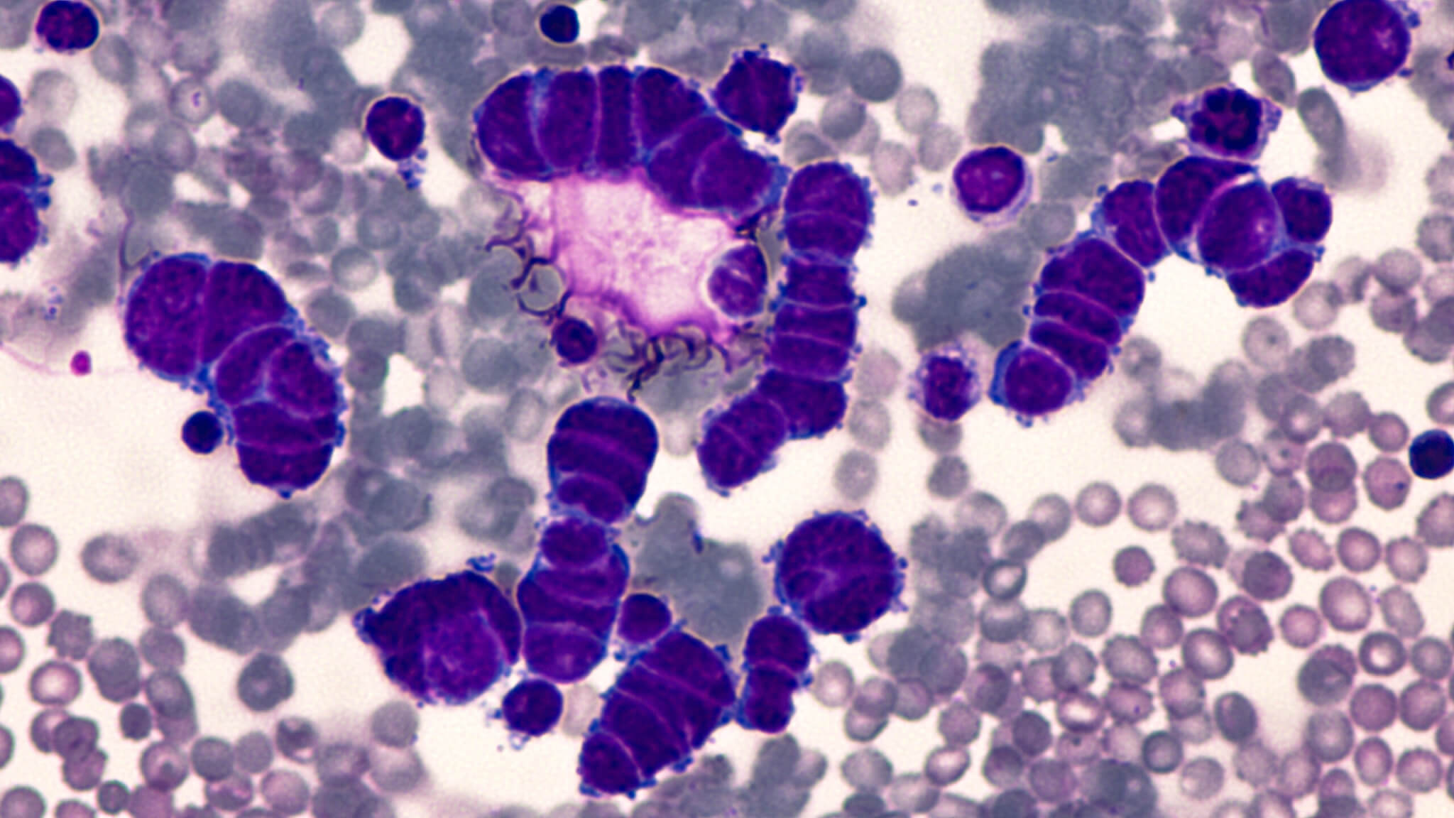 Lung Cancer Awareness: Microscopic image of pleural fluid cytology of a small cell (oat cell) carcinoma from a patient with a history of smoking, demonstrating characteristic nuclear molding.