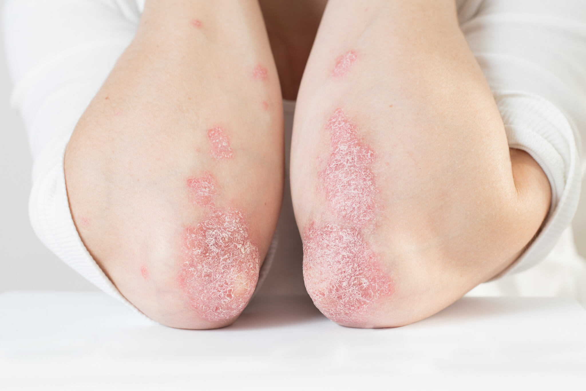 Acute psoriasis on the elbows is an autoimmune incurable dermatological skin disease.